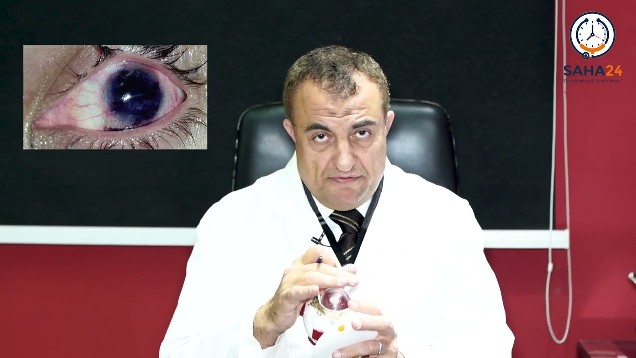 الأستاذ الدكتور أسامة النحراوي يوضح طريقة تلوين القرنية البيضاء فى العيون التالفة.