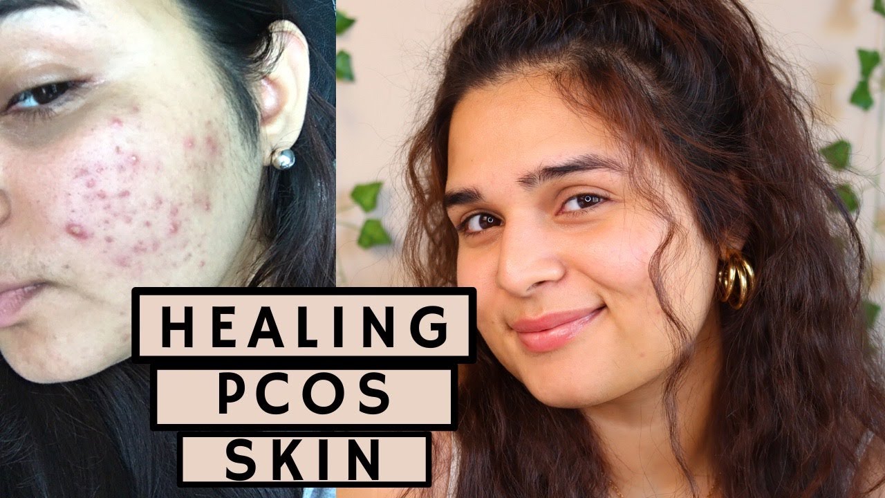 Healing My Skin From PCOS Acne and Marks At Home - 2022