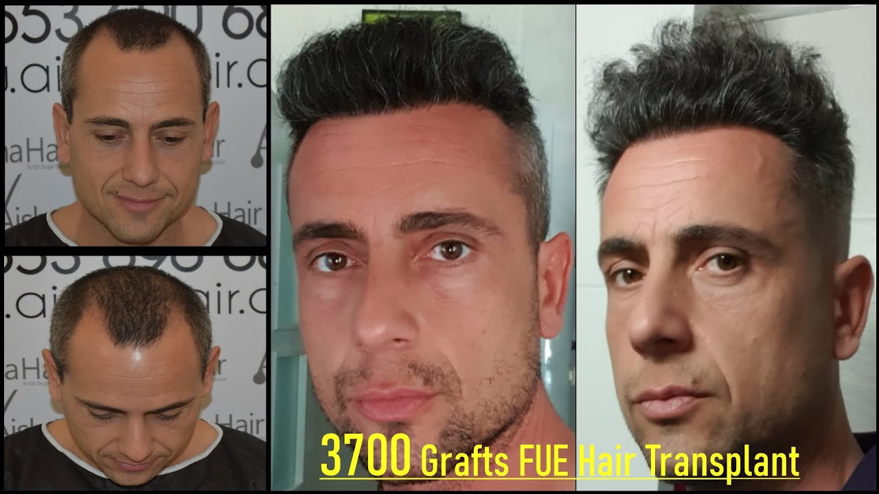3700 Grafts FUE Hair Transplant Before After / 3700 Folículos FUE Trasplante de Pelo Antes y Después