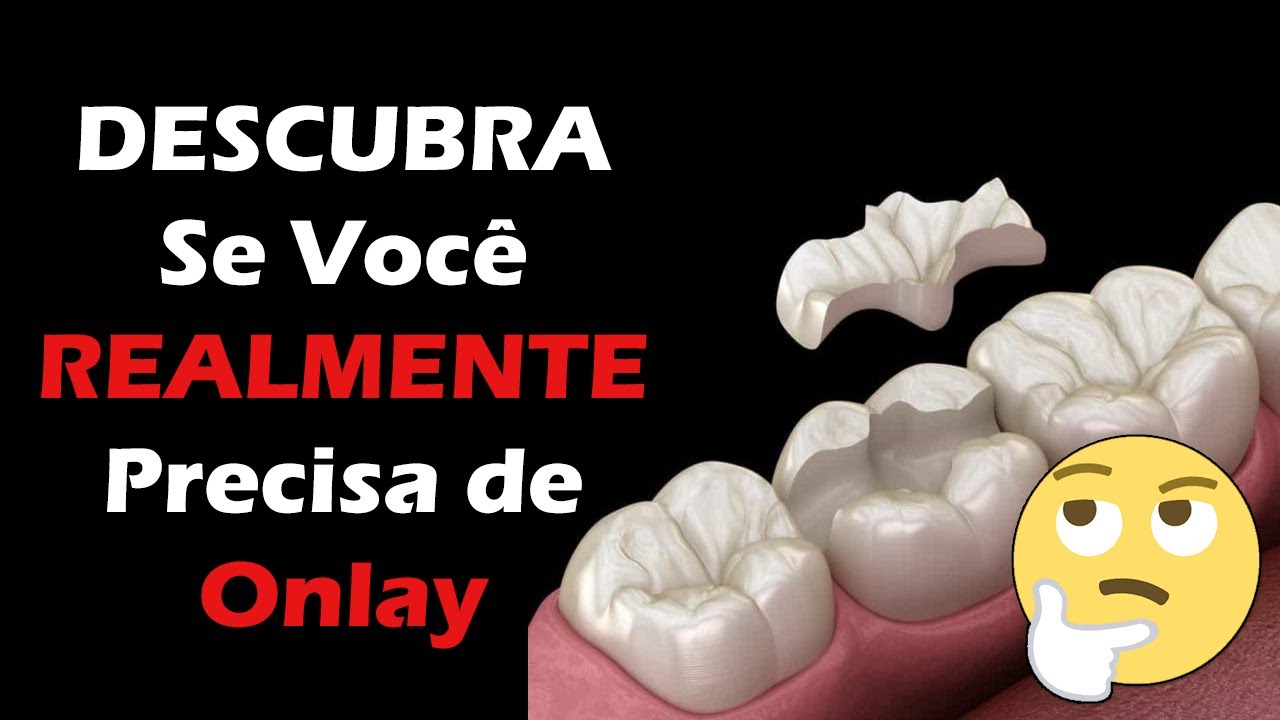 Onlay e Inlay - Como Saber se REALMENTE Preciso do Bloco Dentário? - O Que é, Preço, Indicações