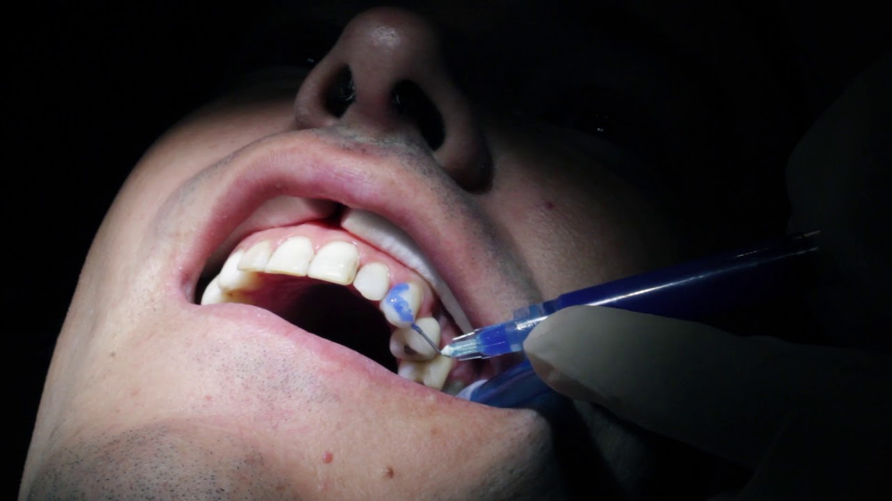 &iquest;Qu&eacute; son las Carillas Dentales? - Colocaci&oacute;n de Carillas Dentales paso a paso