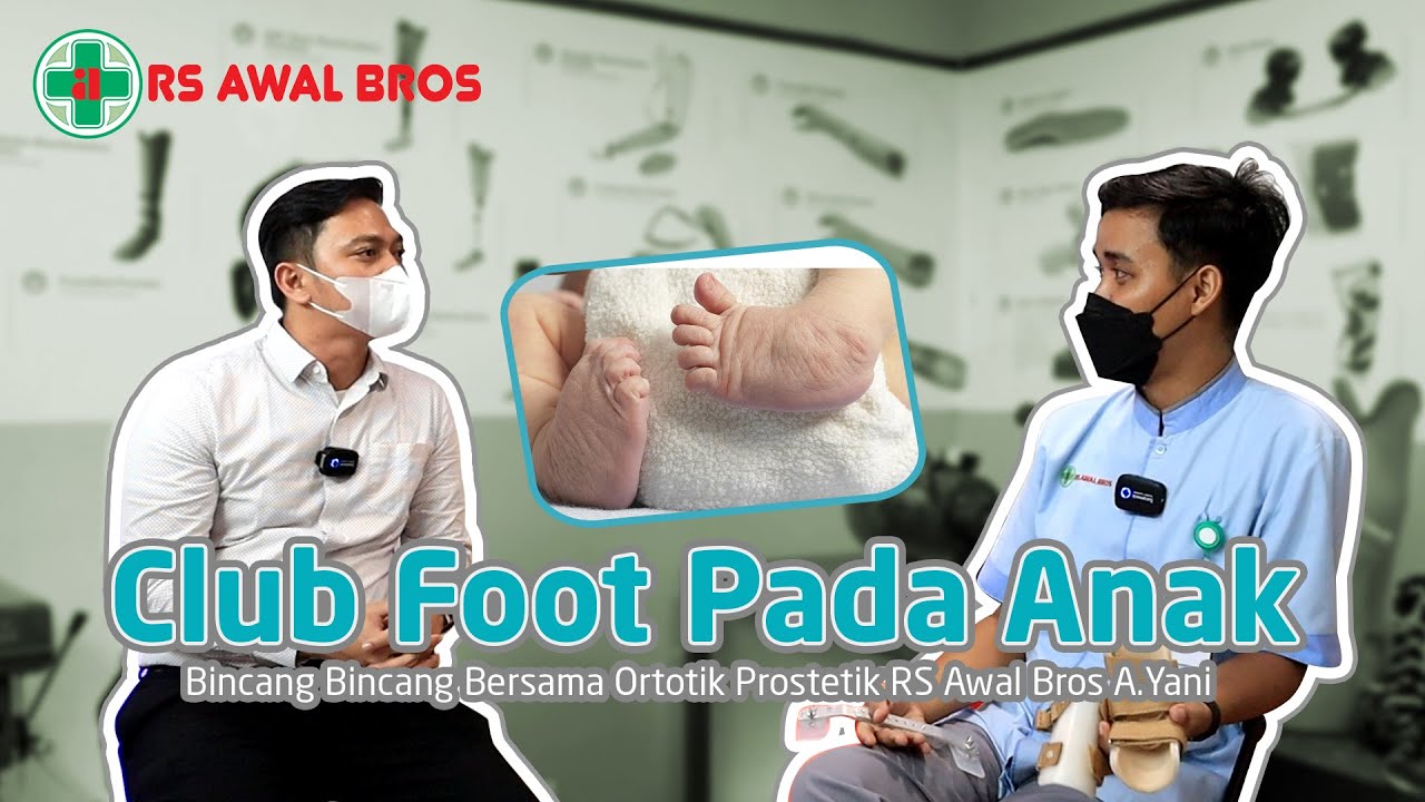 Penanganan Club Foot pada Anak