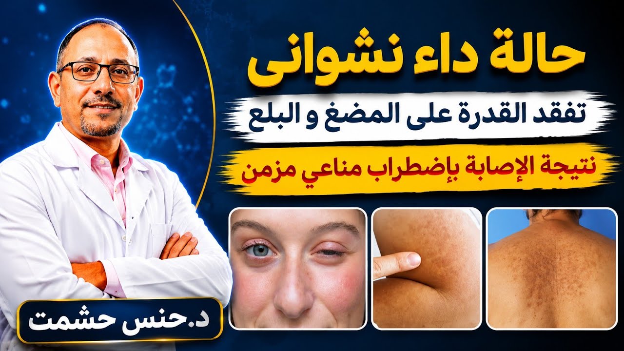 إحذر القرفة سلاح ذو حدين لمرضى الداء النشواني/علاقة الداء النشواني بمشاكل الغدة الدرقية و كيفية حلها