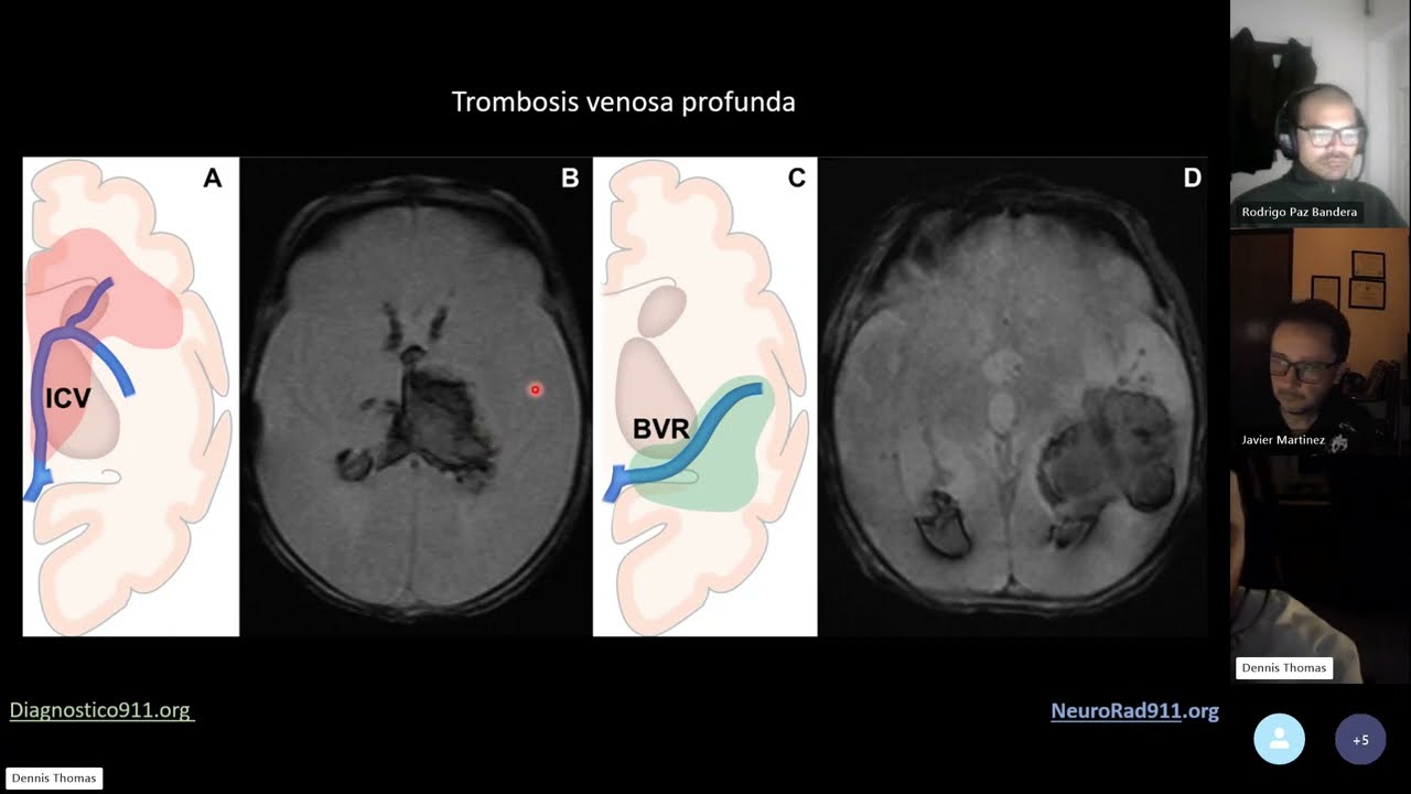Accidente cerebrovascular neonatal Venoso
