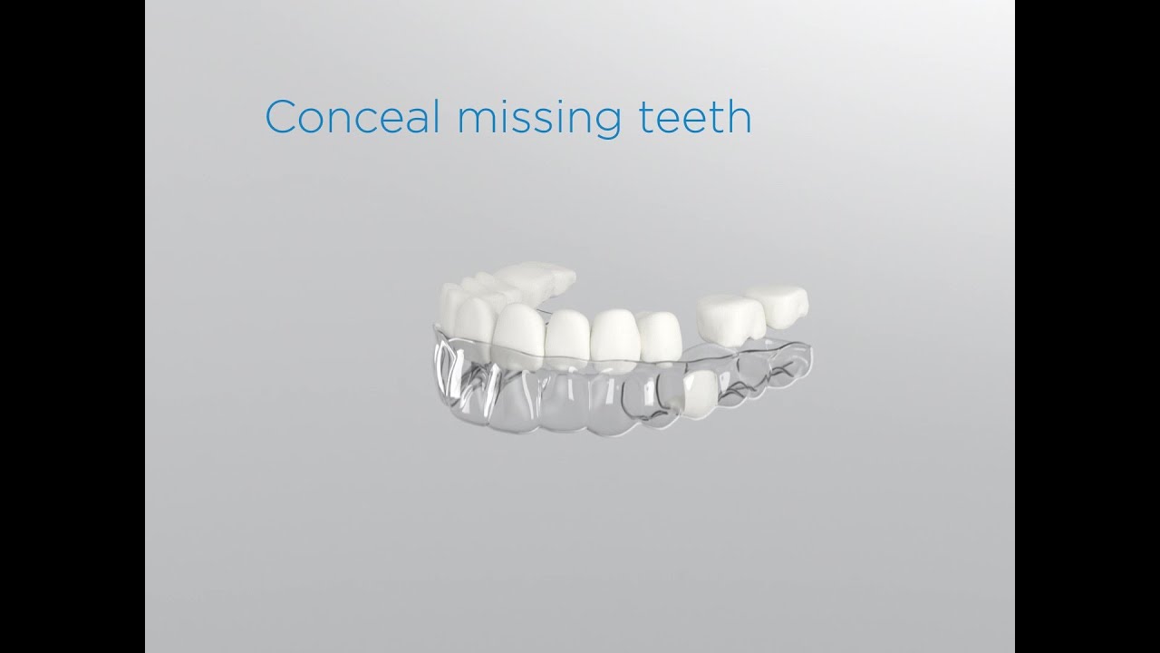 SureSmile Aligners Pontics