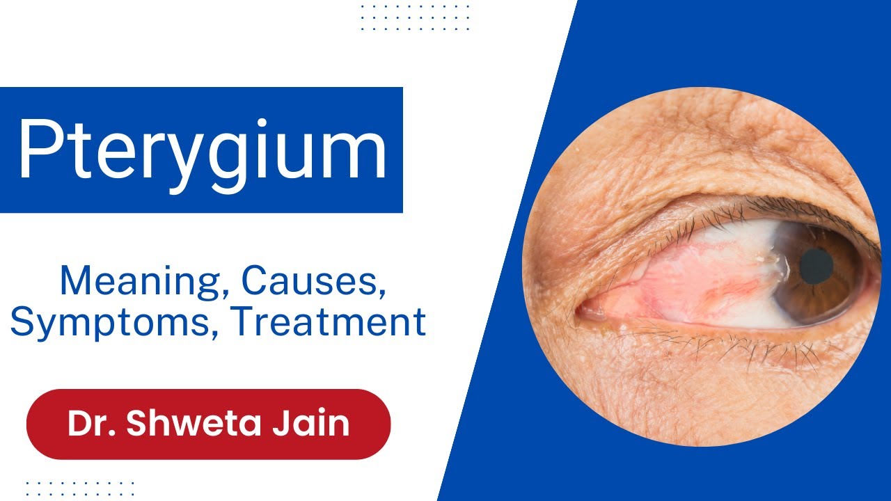 Pterygium: Meaning, Causes, Symptoms, Treatment & Recurrence Rate | Surfer Eye Treatment