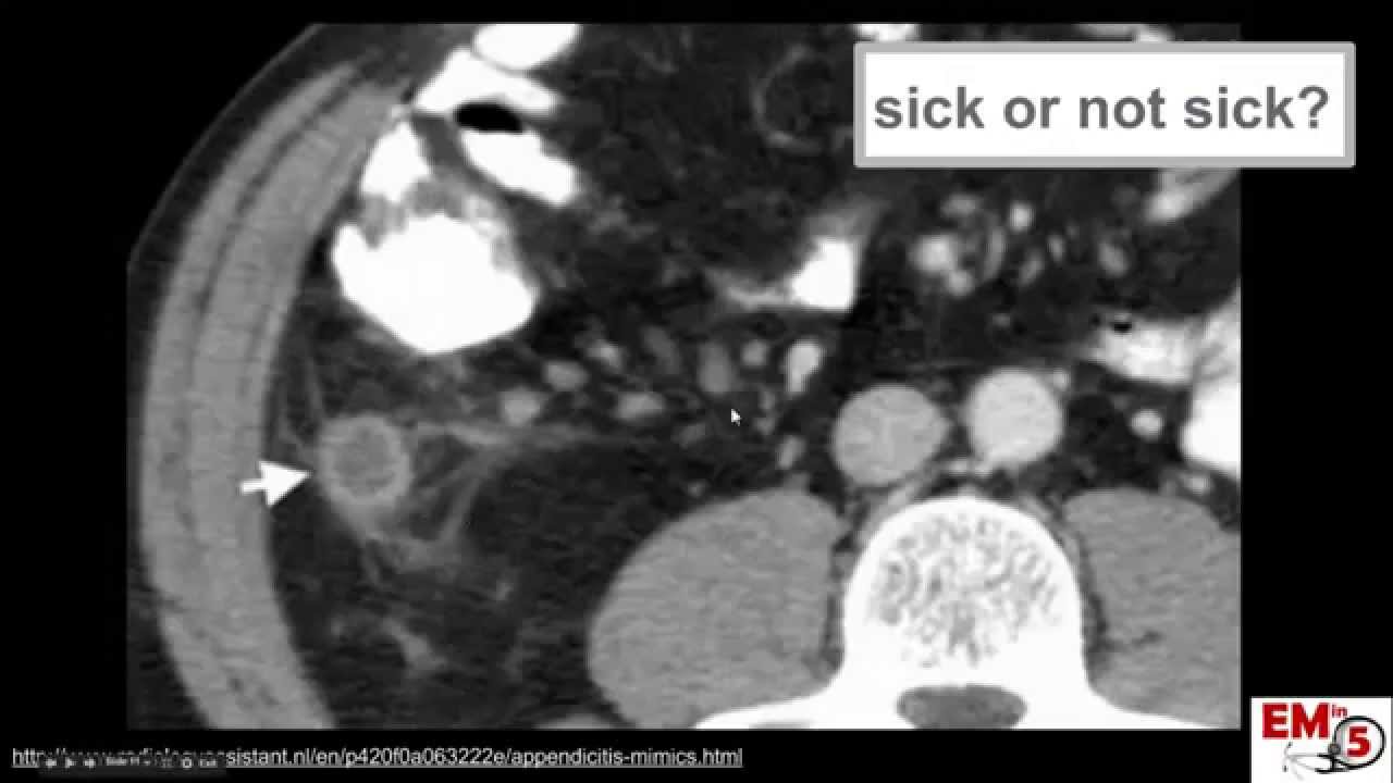 CT Imaging: Appendicitis