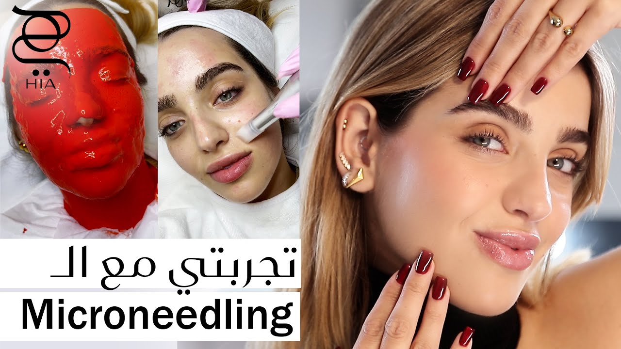تجربتي مع الميكرونيدلينغ 💉 ماهي ابرز فوائده ونصائح لتجنب أضراره 🌸 مع نجلا مسعد
