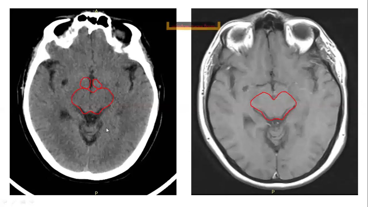 Organs at risk in Brain radiotherapy ( their constraints & how to  delineate )