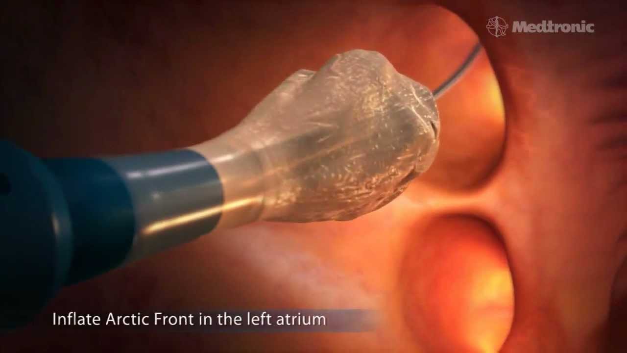Arctic Front CryoAblation Procedure