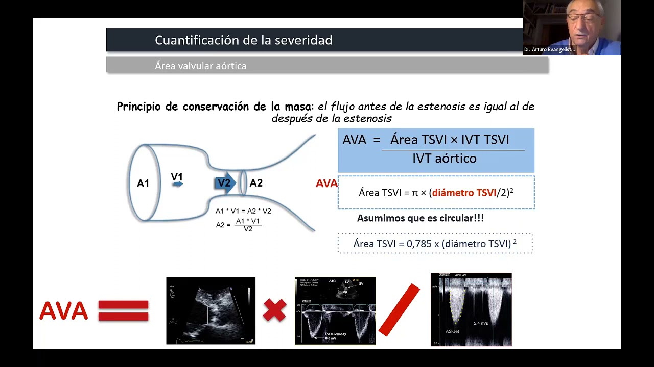 Webinar FAC - Valvulopatías. Estado del arte en Diagnóstico y Tratamiento 2021