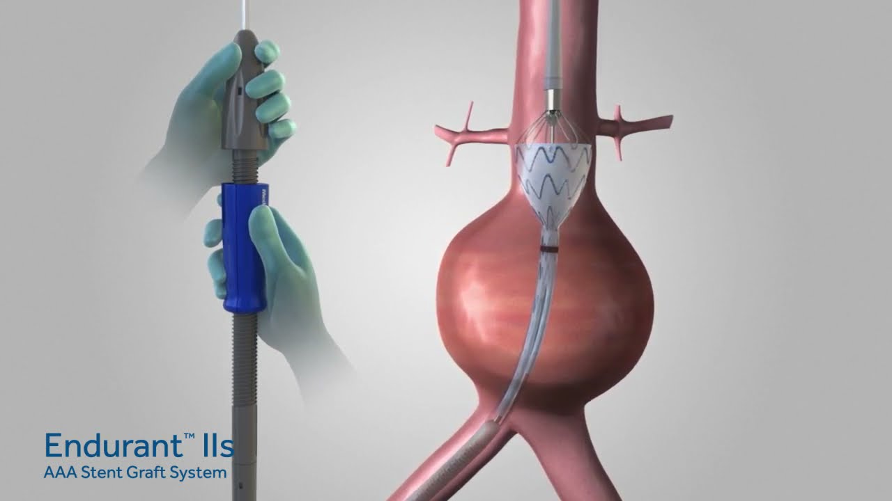 Имплантация стент-графта Endurant IIs