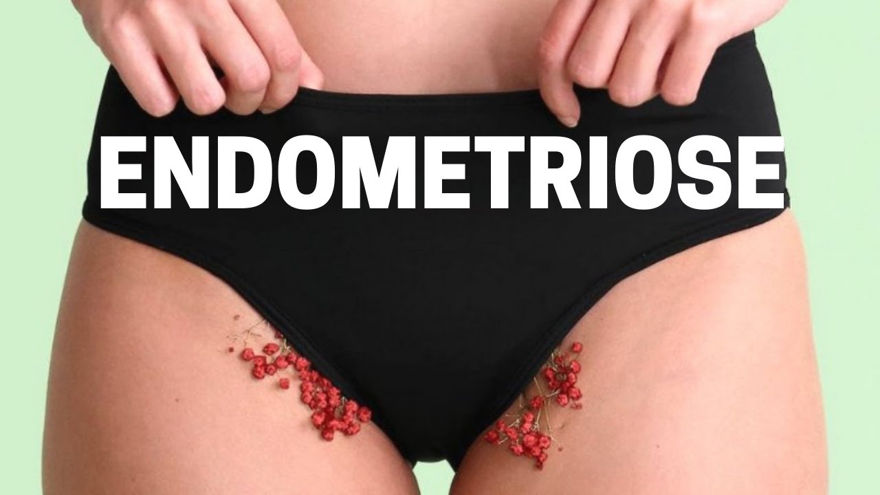 ENDOMETRIOSE: SINTOMAS, O QUE É? TEM CURA?