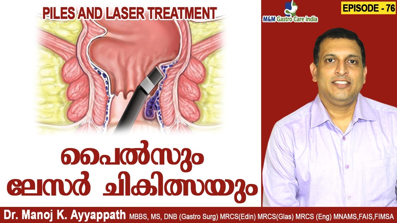 പൈൽസും ലേസർ ചികിത്സയും |Piles & Laser Treatment | M&M Gastro Care India