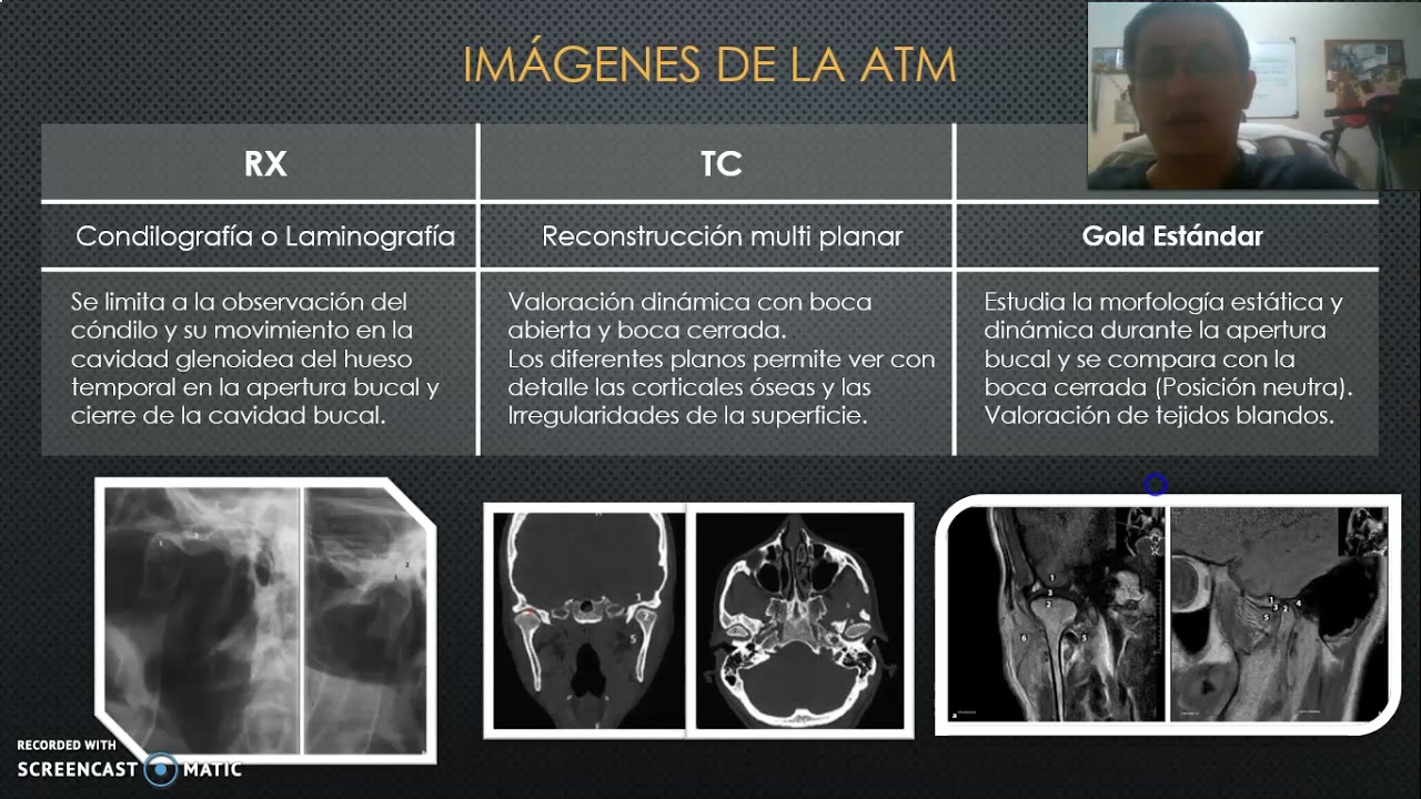 Articulación Temporo Mandibular