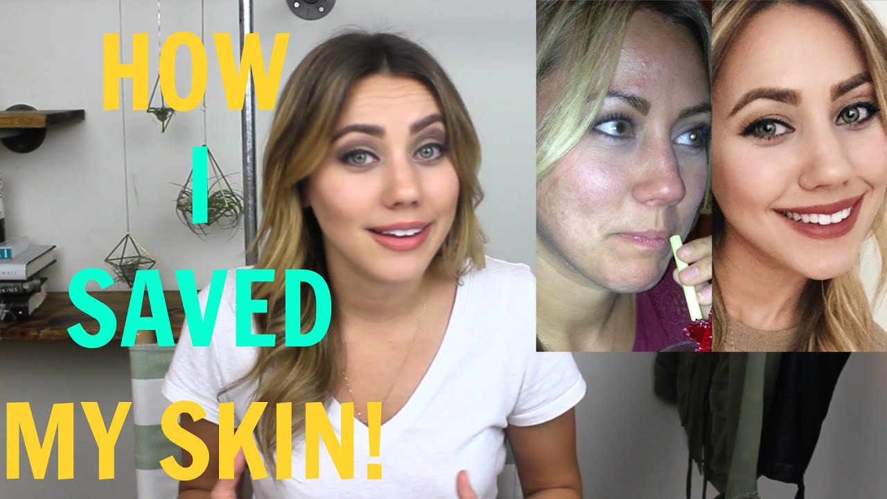 How I Beat My Acne | Oil Cleansing Method