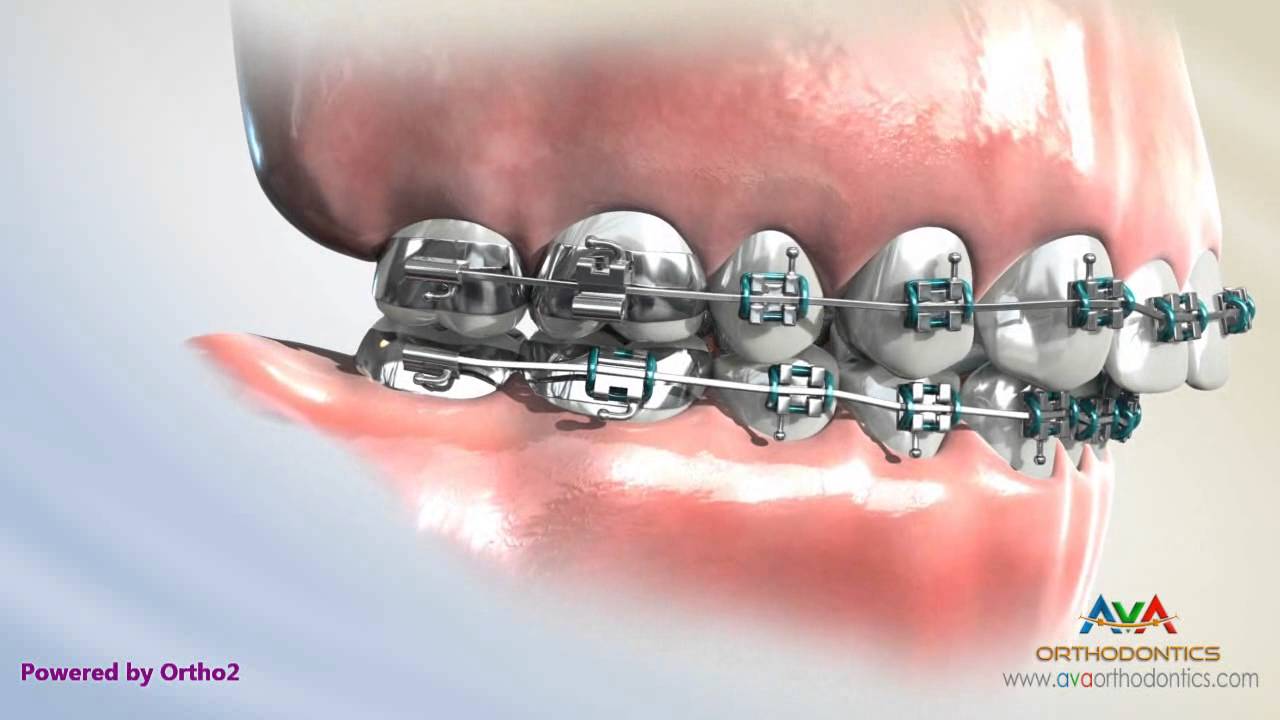 Orthodontics Treatment for Overjet (Overbite) - Headgear vs. Forsus Appliance