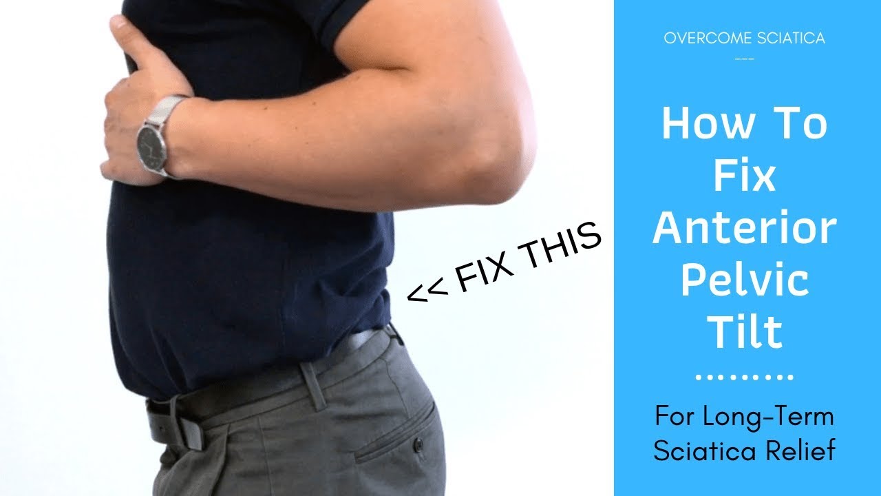 How to Fix an Anterior Pelvic Tilt for Sciatica Pain Relief