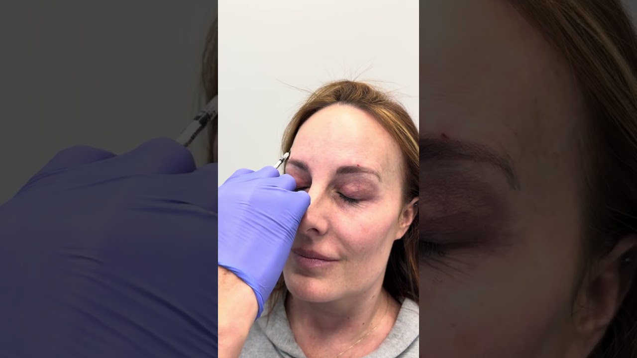 Custom tox treatment part 1
