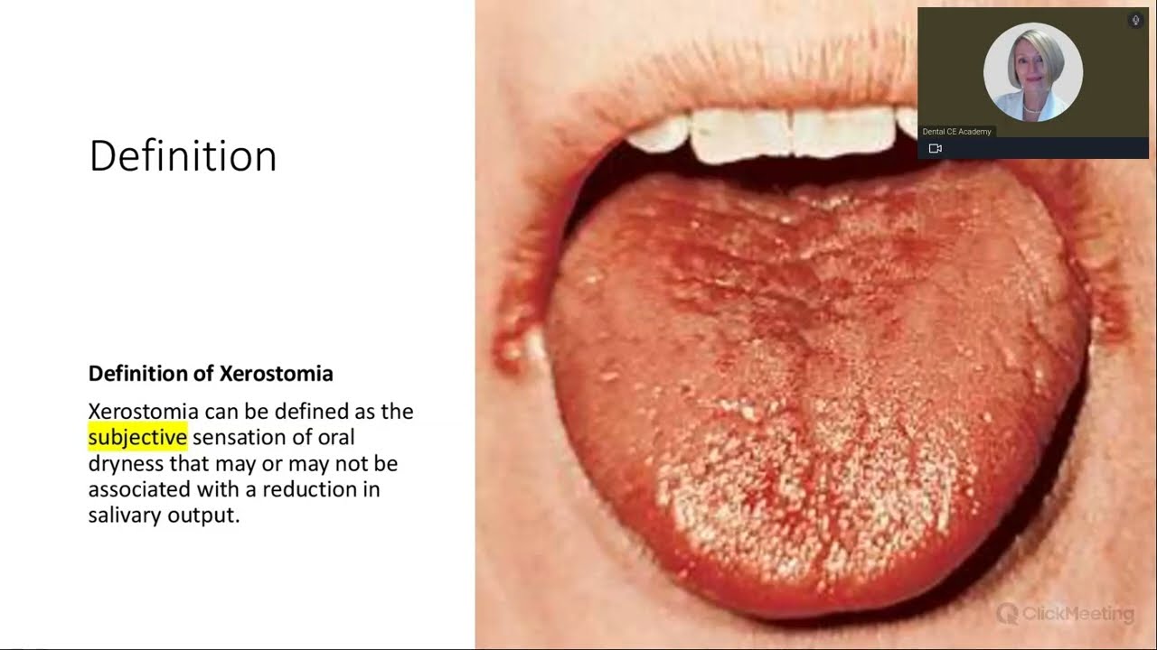 XEROSTOMIA  TREATING DRY MOUTH TO IMPROVE PATIENT OUTCOMES