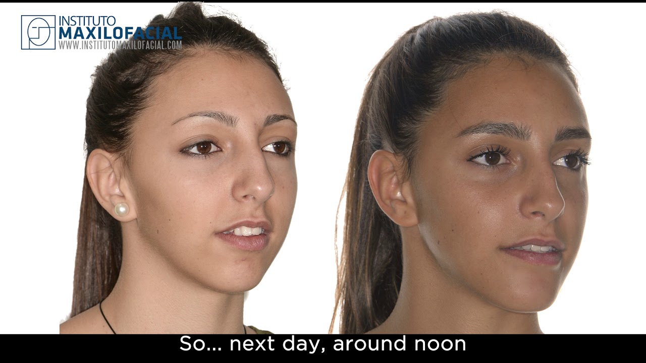 GEMMA: Class II, open bite, long-face sydrome, biretrusion - bimaxillary surgery, mentoplasty