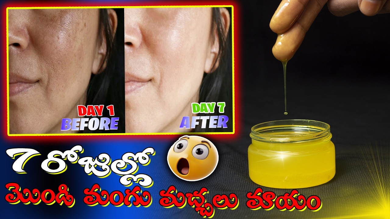  Pigmentation Home Remedy Telugu lo | Get Rid Of Pigmentation Telugu videos