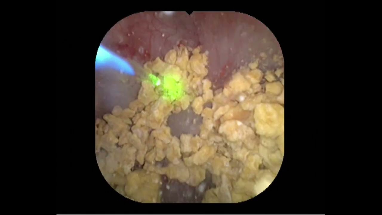 RIRS FOR MULTIPLE UPPER URETERIC CALCULI