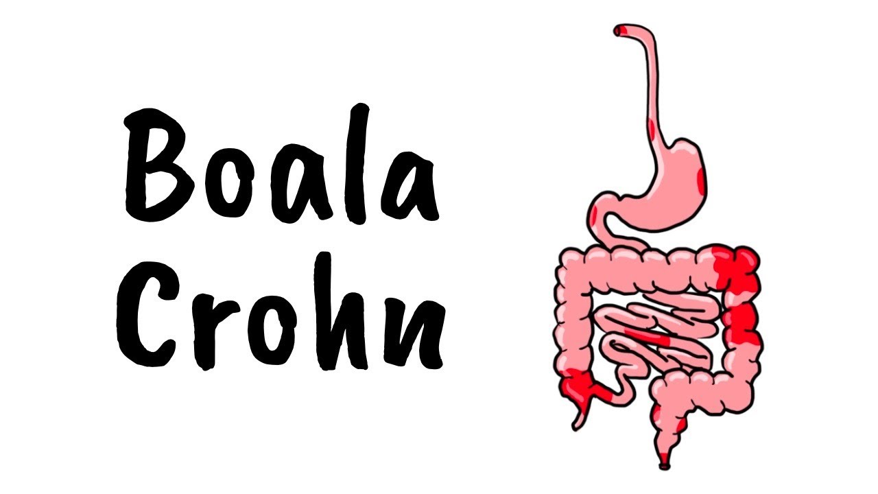 BOALA CROHN
