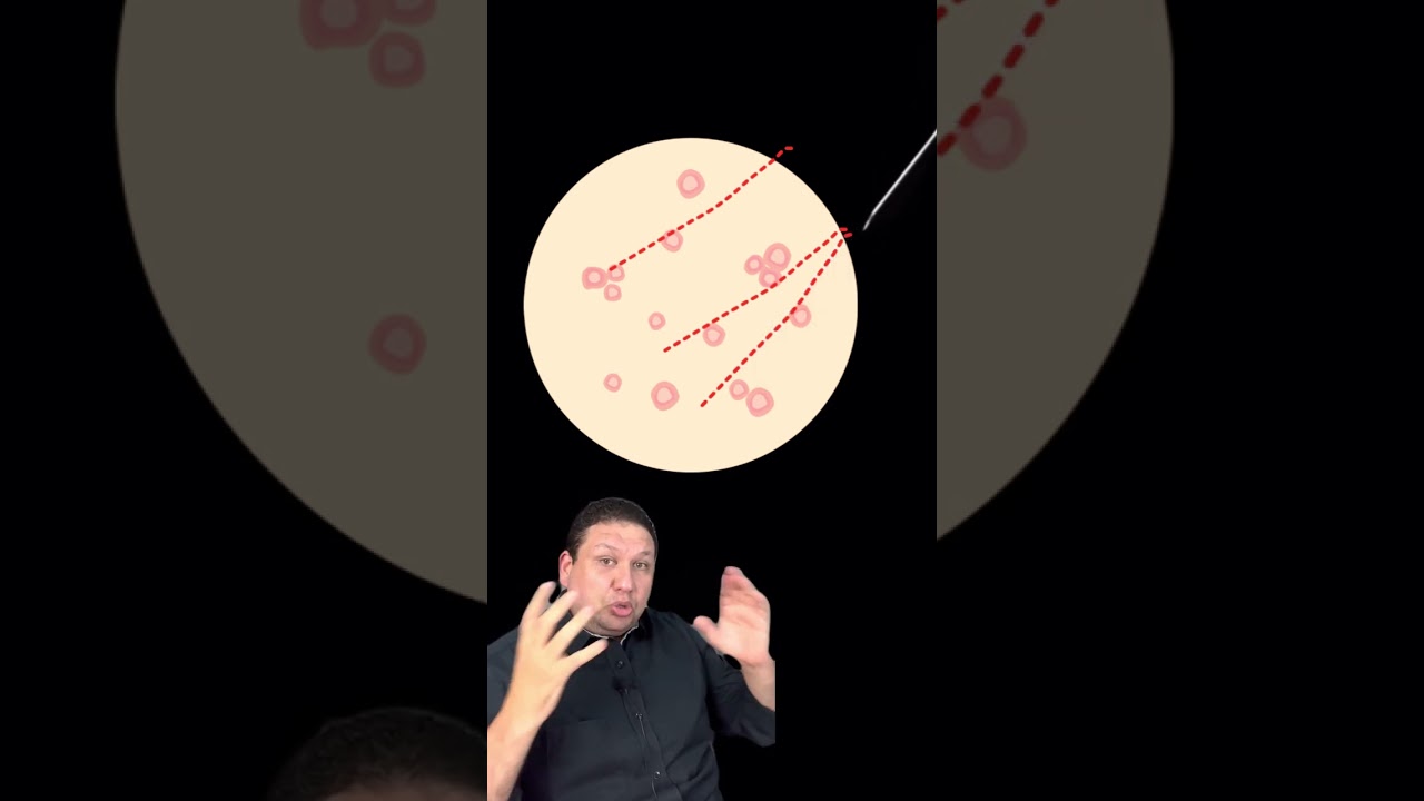 O n&oacute;dulo de tire&oacute;ide com a pun&ccedil;&atilde;o benigna pode ser c&acirc;ncer de tire&oacute;ide?