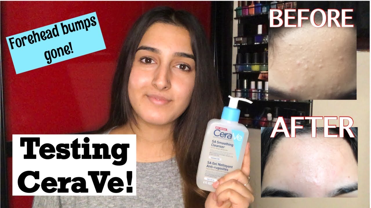 Testing CeraVe SA Smoothing Cleanser And Cream! | Cure Forehead Bumps And Keratosis Pilaris