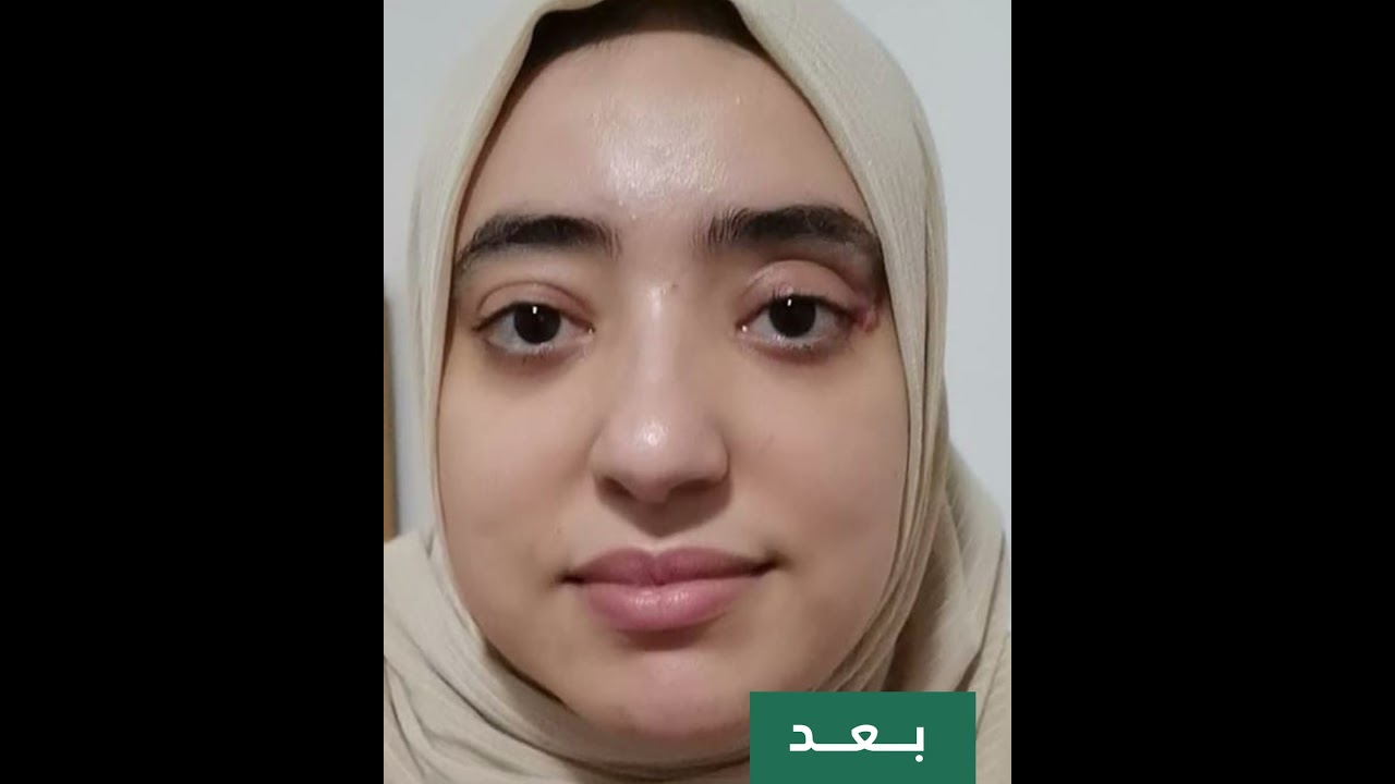 علاج جحوظ العين