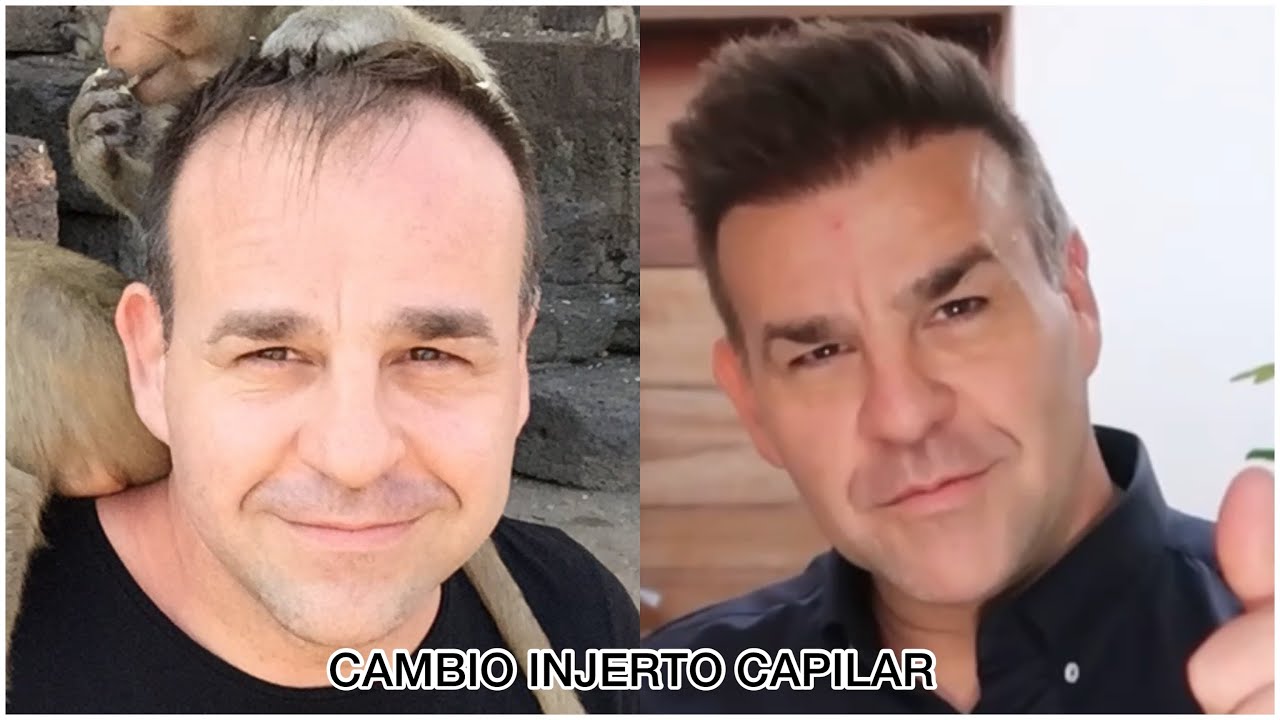 ANTES Y DESPUÉS INJERTO CAPILAR