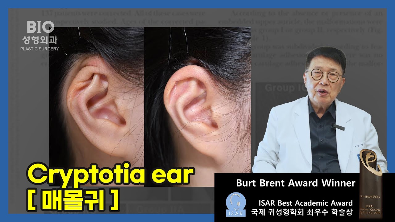 BIO성형외과 박철원장 매몰귀 수술방법에 대해서 자세히 알려드립니다.