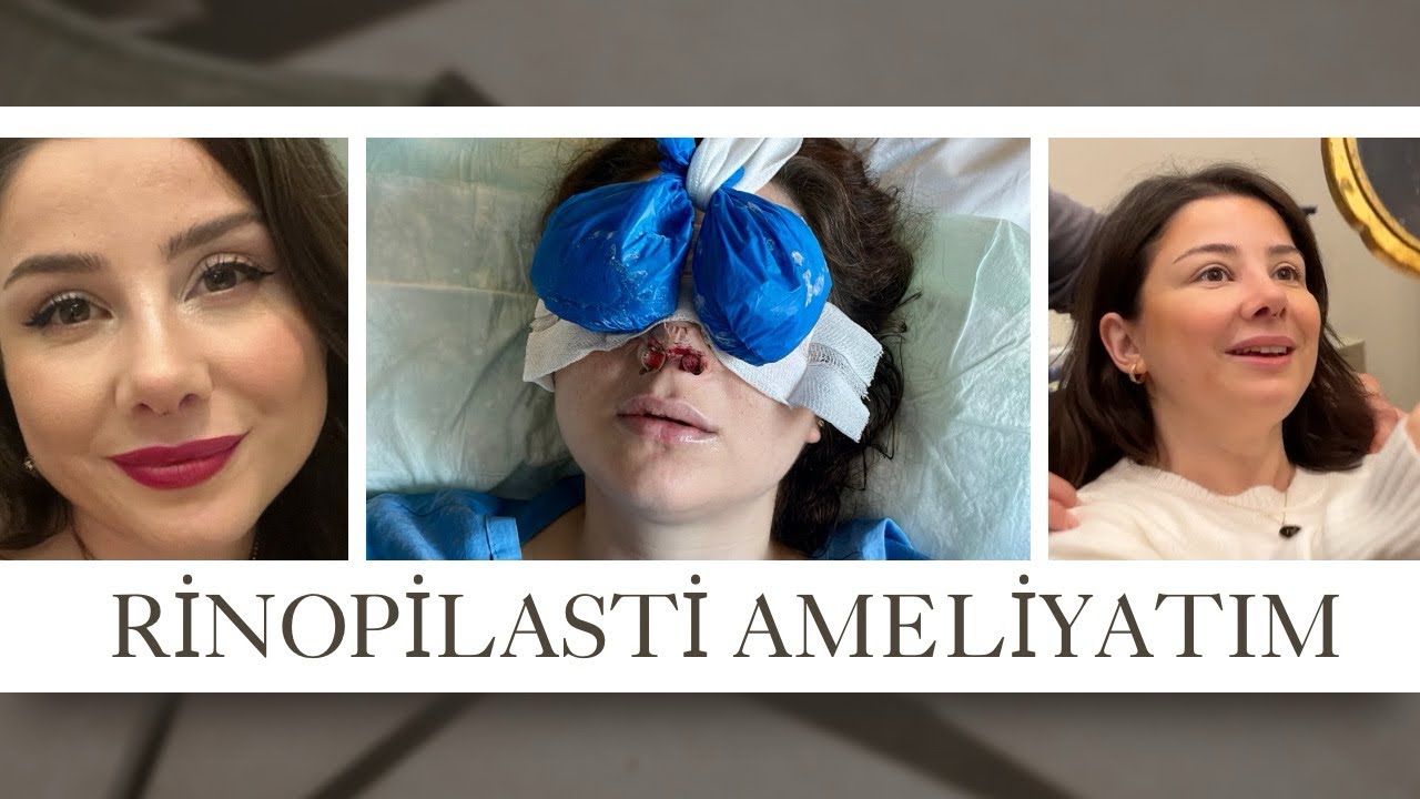 BURUN AMELİYATIM - Sprey Bağımlılığı ve Ameliyatla İlgili Tüm Süreçler - Hastane Vlog 😷👃🏽