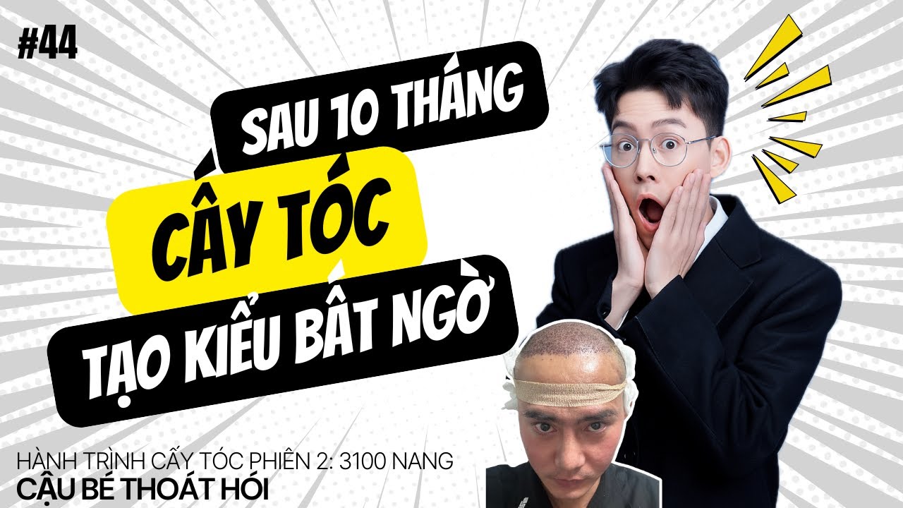 SAU 10 THÁNG CẤY TÓC TẠO KIỂU BẤT NGỜ #44 l Hành Trình Cấy Tóc
