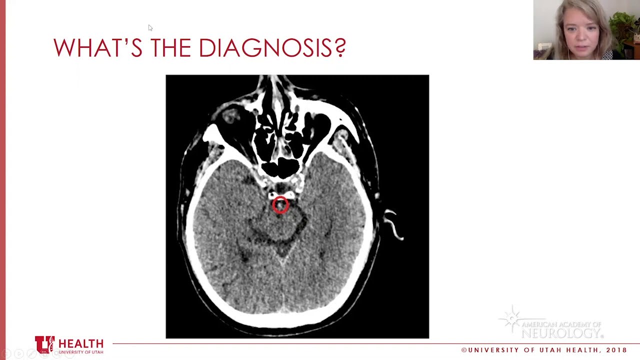 Subspecialty Discussion: Vascular Neurology - American Academy of Neurology