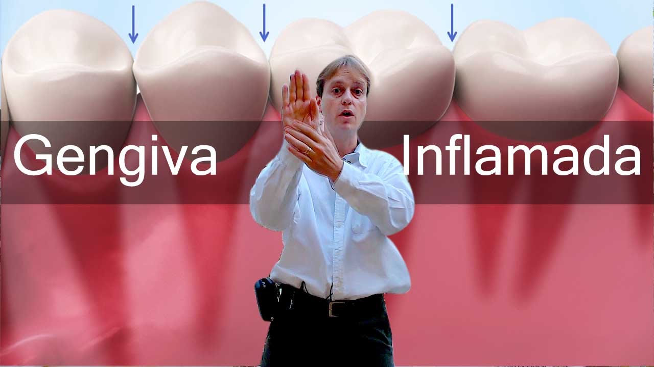 Doenças Gengivais (Gengivite) e Periodontais (Periodontite)