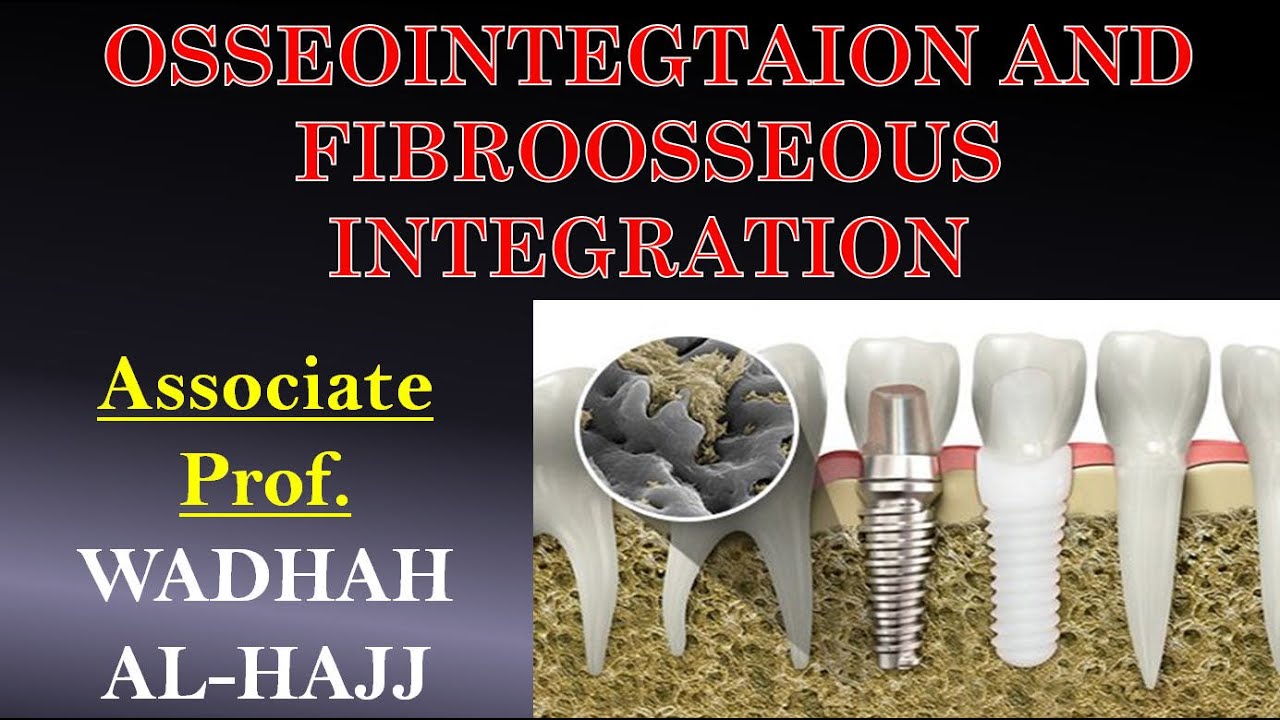 3- Osseo-integration and fibro-osseous integration. Dr Wadhah implantology lectures.  د/ وضاح الحاج