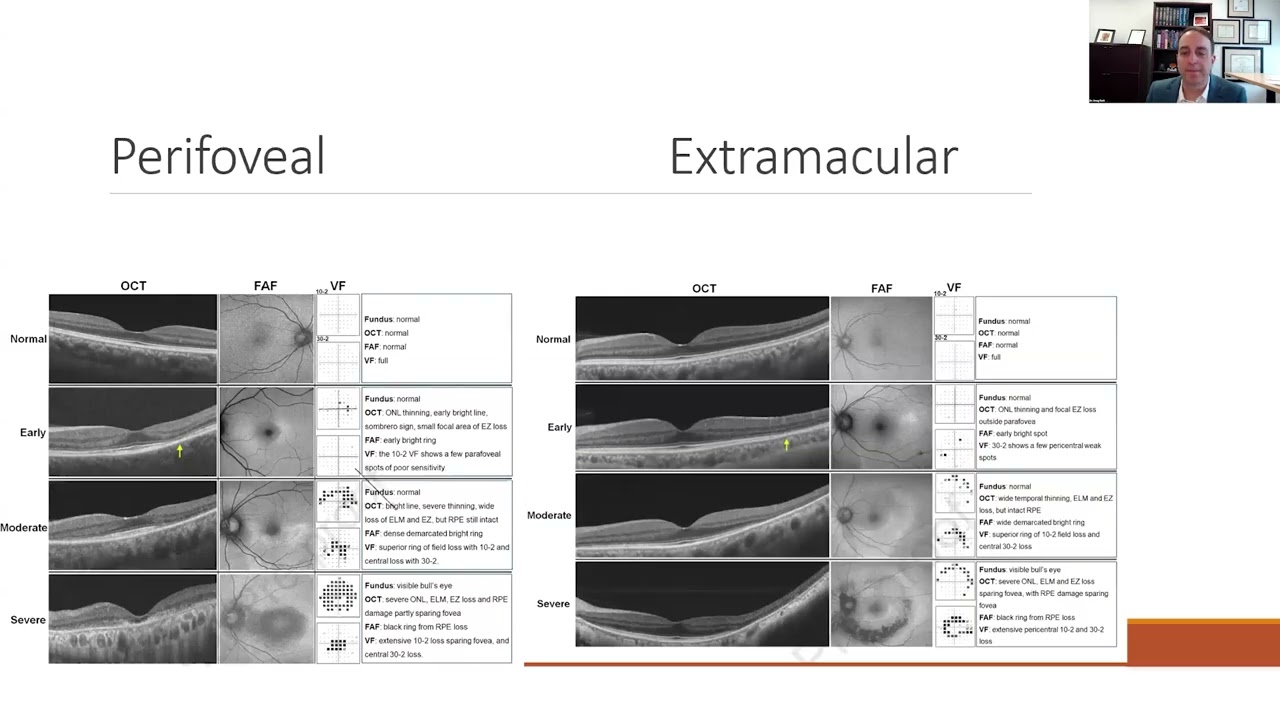 Lecture: Ocular Side Effects of Common Oral Medication