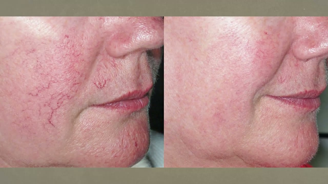 PULSED DYE LASER: Kılcal Damar, Kızarık Yüz, Porto Şarabı Lekesi, Rozasea Tedavisi