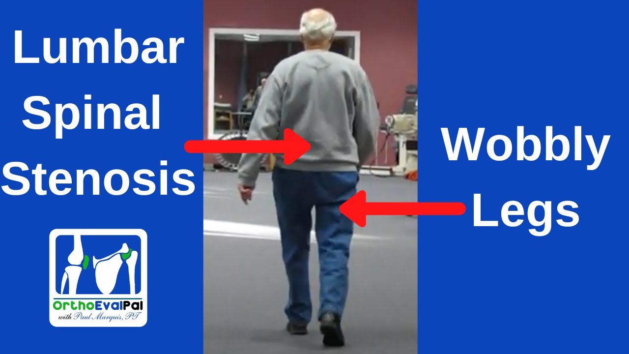 Lumbar Spinal Stenosis Symptoms (Neurogenic Claudicatiion)