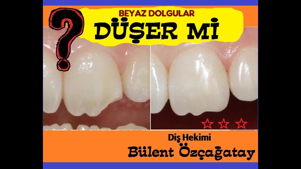 Beyaz Dolgu Duser mi?    Dt.Bülent Özçağatay