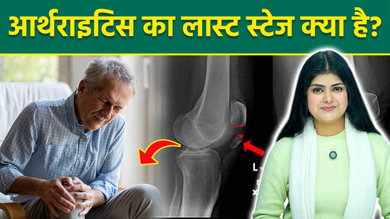 Arthritis Last Stage: What is the treatment for arthritis, Rheumatoid Arthritis Symptoms & Home Remedies..|Boldsky