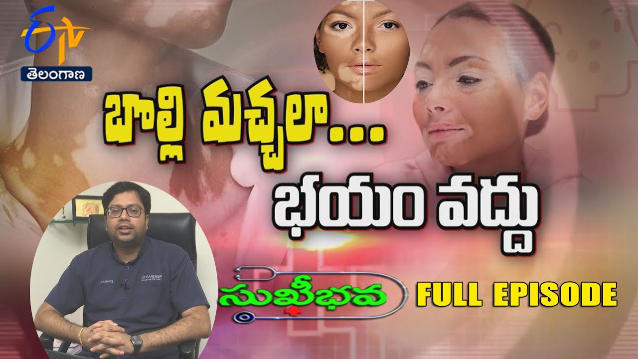 About Vitiligo | Sukhibhava | 25th June 2024 | | Full Episode | ETV Telangana