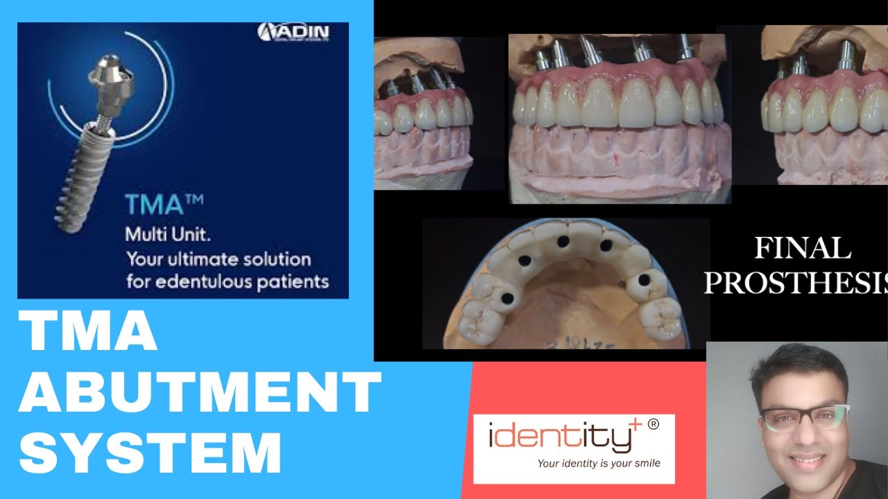 TMA Abutment | Dr. Sharad Gupta