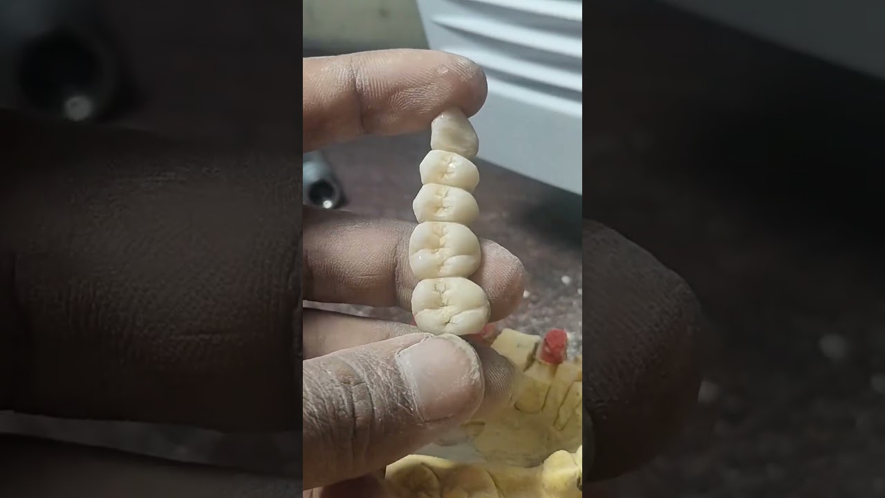 Pfm Molar and premolar anatomy