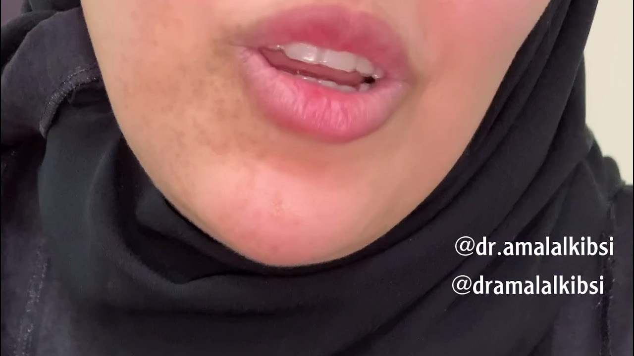 Invisalign experience after failures by metal braces تجربة انفزلاين بعد تجارب فاشلة باتقويم المعدني
