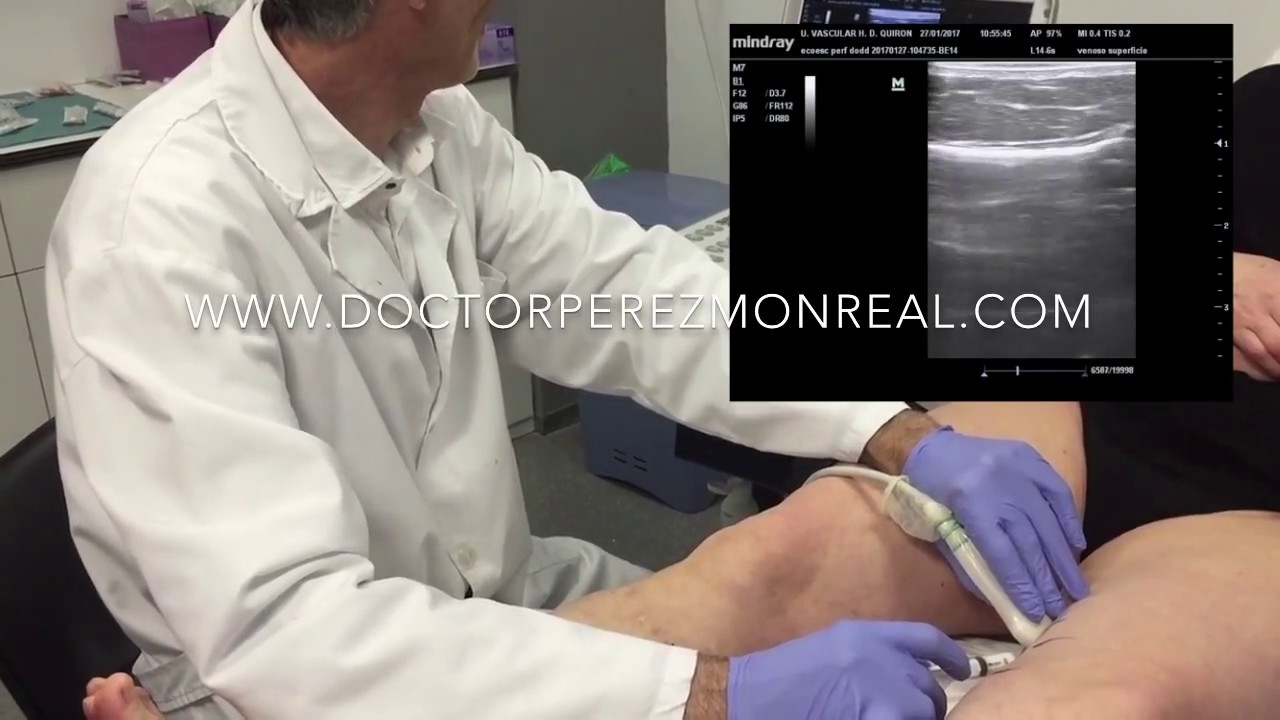 esclerosis ecoguiada espuma safena interna/perforante de Dodd Dr P&eacute;rez Monreal