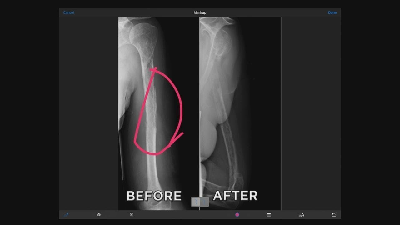 Woman’s Vanishing Bones Explained!