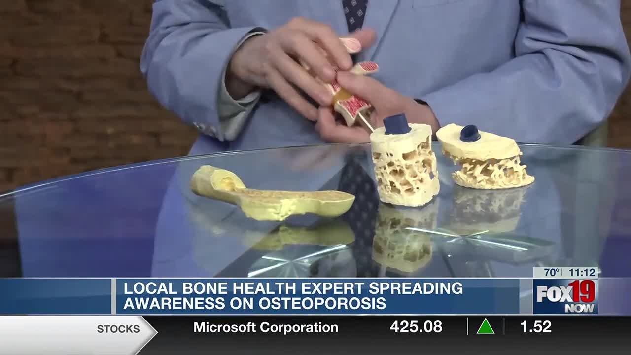 Local bone health expert spreading awareness on osteoporosis